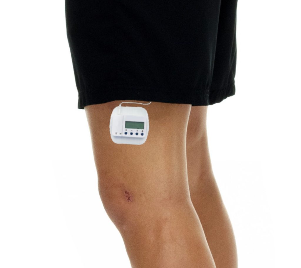 Peripheral Nerve Simulators - Nobility Pain Management